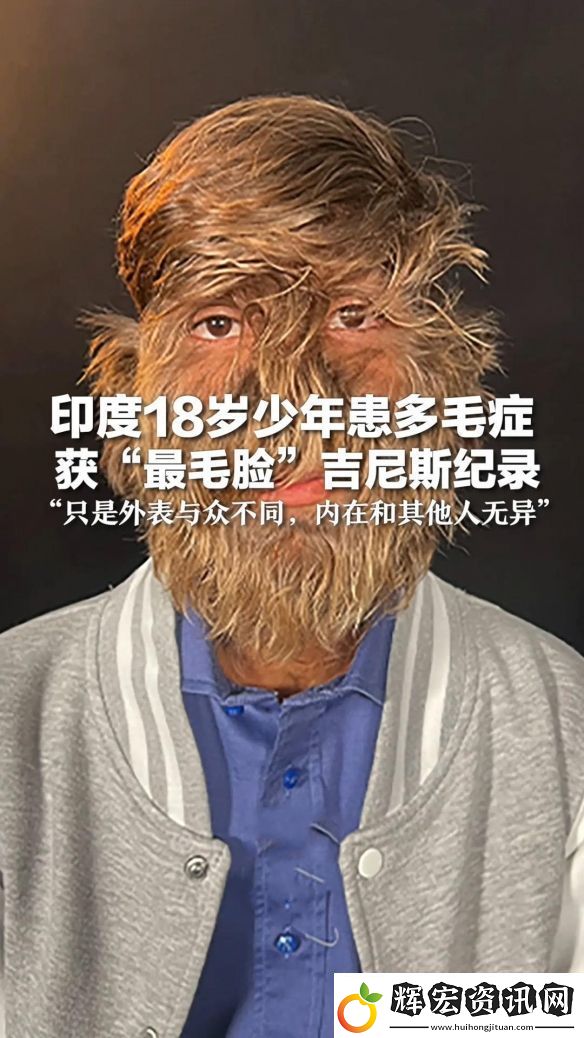 印度少年獲“最毛臉”吉尼斯紀錄